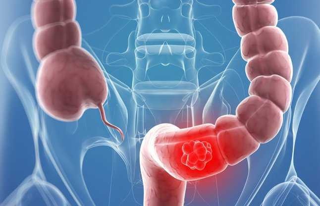 सातौं अन्तर्राष्ट्रिय क्यान्सर सम्मेलन जनकपुरमा